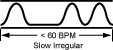 p.slow.irreg p.slow.irreg The Slow Irregular, Knotted, Bound Pulse (Jie Mai)